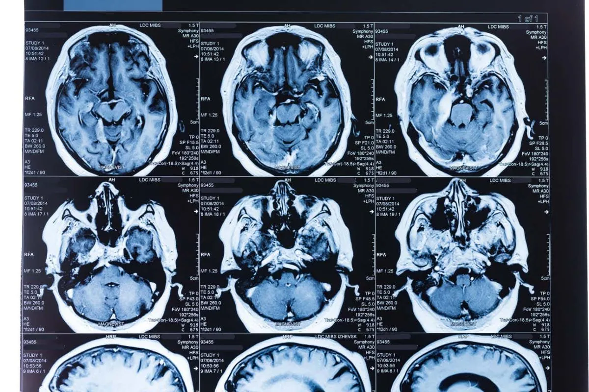 Científicos descubren las edades clave del envejecimiento cerebral